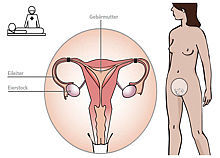 Beschriftete Grafik zeigt die Stellen, an der bei einer Sterilisation die Eileiter verschlossen bzw. verschmolzen werden