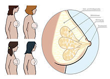 Grafik zeigt 4 unterschiedliche Brustformen. An einer Querschnitt-Grafik wird der anatomische Aufbau einer Brust gezeigt.