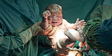 Baby wird per Kaiserschnitt auf die Welt gebracht