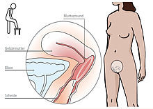 Grafik mit 3 Abbildungen zeigt die Platzierung des Vaginalrings